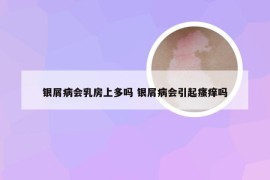 银屑病会乳房上多吗 银屑病会引起瘙痒吗