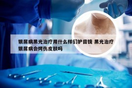 银屑病黑光治疗用什么样们护目镜 黑光治疗银屑病会烤伤皮肤吗