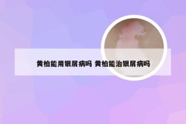 黄柏能用银屑病吗 黄柏能治银屑病吗