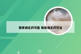 银屑病无药可医 银屑病无药可治