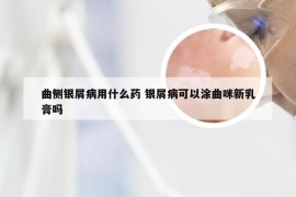 曲侧银屑病用什么药 银屑病可以涂曲咪新乳膏吗