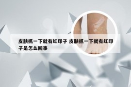 皮肤抓一下就有红印子 皮肤抓一下就有红印子是怎么回事