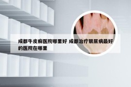 成都牛皮癣医院哪里好 成都治疗银屑病最好的医院在哪里