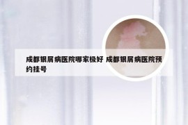 成都银屑病医院哪家极好 成都银屑病医院预约挂号