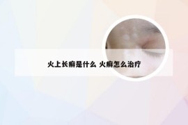 火上长癣是什么 火癣怎么治疗