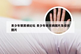 青少年银屑病论坛 青少年银屑病图片及症状图片