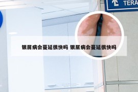 银屑病会蔓延很快吗 银屑病会蔓延很快吗