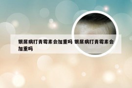 银屑病打青霉素会加重吗 银屑病打青霉素会加重吗