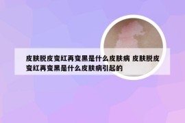 皮肤脱皮变红再变黑是什么皮肤病 皮肤脱皮变红再变黑是什么皮肤病引起的