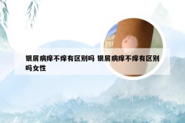 银屑病痒不痒有区别吗 银屑病痒不痒有区别吗女性