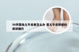 50天婴幼儿牛皮癣怎么办 婴儿牛皮肤癣的症状图片