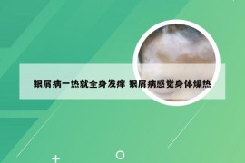 银屑病一热就全身发痒 银屑病感觉身体燥热