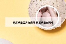 银屑病是否为白癜风 银屑病是白斑吗