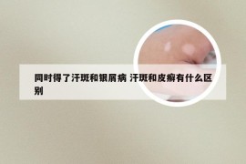 同时得了汗斑和银屑病 汗斑和皮癣有什么区别