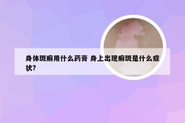 身体斑癣用什么药膏 身上出现癣斑是什么症状?