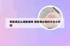 银屑病怎么缓解瘙痒 银屑病止痒的方法小妙招