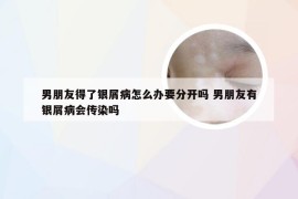 男朋友得了银屑病怎么办要分开吗 男朋友有银屑病会传染吗