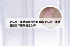 庐江马厂皮肤医院治疗银屑病 庐江马厂皮肤医院治疗银屑病怎么样