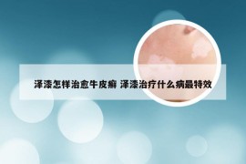 泽漆怎样治愈牛皮癣 泽漆治疗什么病最特效