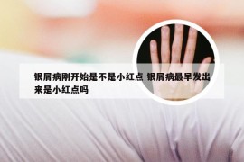 银屑病刚开始是不是小红点 银屑病最早发出来是小红点吗