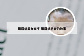 银屑病美女知乎 银屑病患者的故事