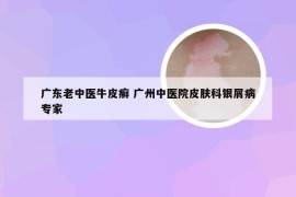 广东老中医牛皮癣 广州中医院皮肤科银屑病专家