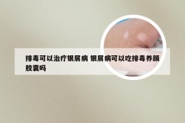 排毒可以治疗银屑病 银屑病可以吃排毒养颜胶囊吗