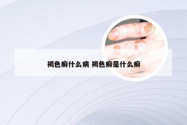 褐色癣什么病 褐色癣是什么癣