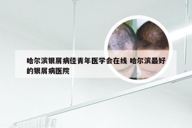 哈尔滨银屑病佳青年医学会在线 哈尔滨最好的银屑病医院