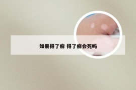 如果得了癣 得了癣会死吗