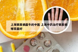 上海银屑病最牛的中医 上海中药治疗银屑病哪家最好