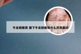 牛皮癣腋窝 腋下牛皮肤癣用什么药膏最好