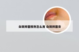 白斑抑菌擦剂怎么用 白斑抑菌膏