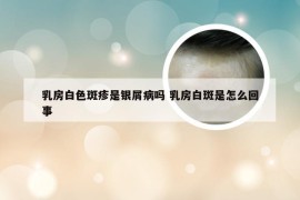 乳房白色斑疹是银屑病吗 乳房白斑是怎么回事