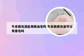 牛皮癣洗澡能用精油皂吗 牛皮肤癣洗澡可以用香皂吗