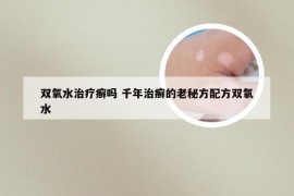 双氧水治疗癣吗 千年治癣的老秘方配方双氧水