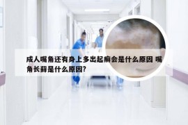 成人嘴角还有身上多出起癣会是什么原因 嘴角长藓是什么原因?