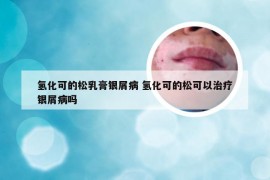 氢化可的松乳膏银屑病 氢化可的松可以治疗银屑病吗