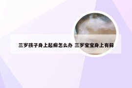 三岁孩子身上起癣怎么办 三岁宝宝身上有藓