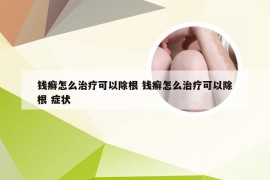 钱癣怎么治疗可以除根 钱癣怎么治疗可以除根 症状