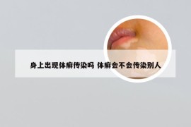 身上出现体癣传染吗 体癣会不会传染别人