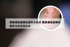 银屑病消退期头部长小红点 银屑病消退期头部长小红点怎么办