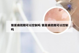 银屑病初期可以控制吗 银屑病初期可以控制吗