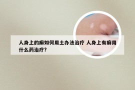 人身上的癣如何用土办法治疗 人身上有癣用什么药治疗?