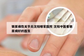 银屑病性关节炎沈阳哪家医院 沈阳中医看银屑病好的医生