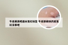 牛皮癣滴吧遇水变红标签 牛皮肤癣抹药就变红没事吧