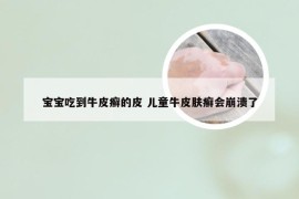 宝宝吃到牛皮癣的皮 儿童牛皮肤癣会崩溃了