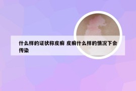 什么样的证状称皮癣 皮癣什么样的情况下会传染