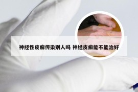 神经性皮癣传染别人吗 神经皮癣能不能治好