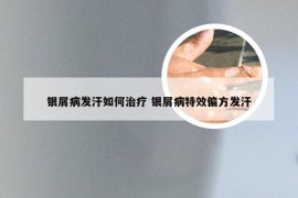 银屑病发汗如何治疗 银屑病特效偏方发汗